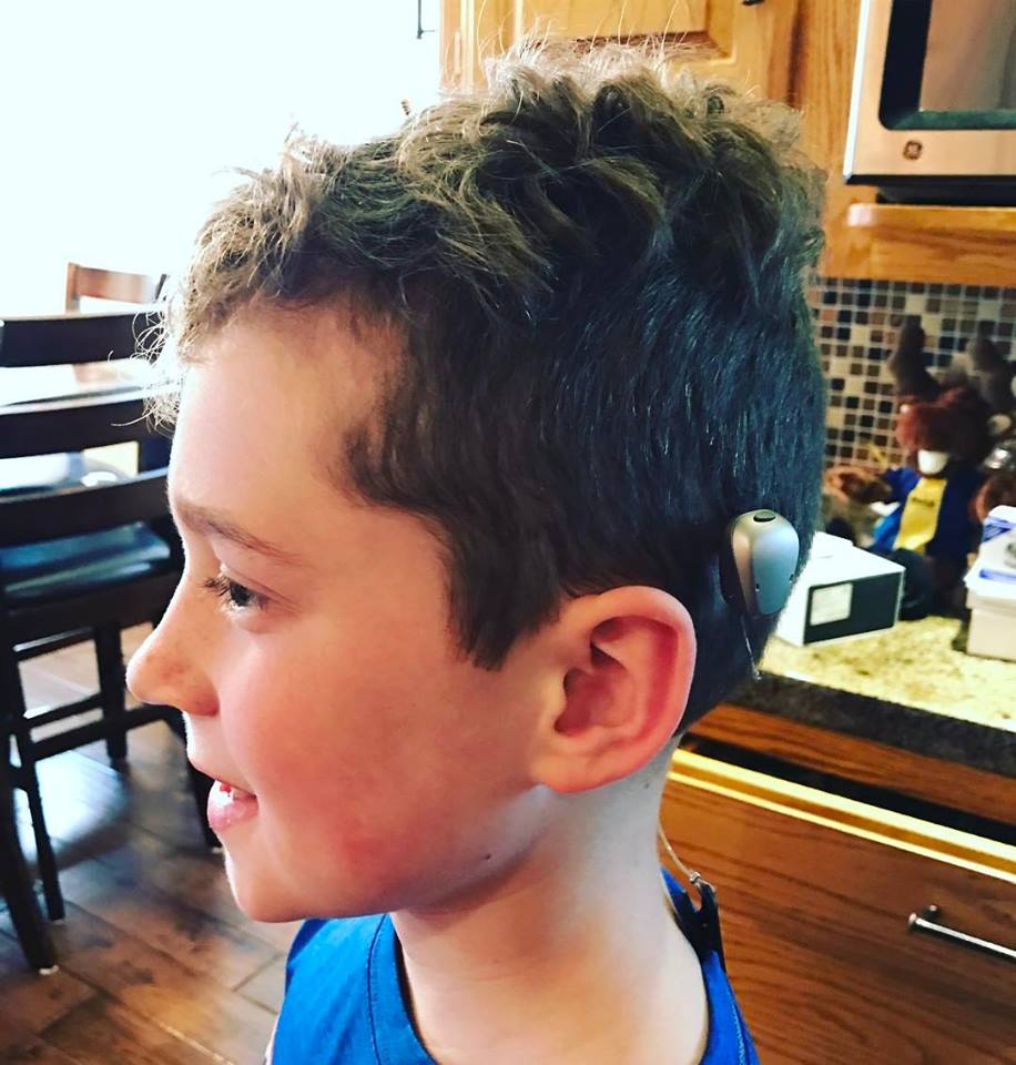 A profile of a caucasian boy with a bone anchored hearing aid behind his ear. 