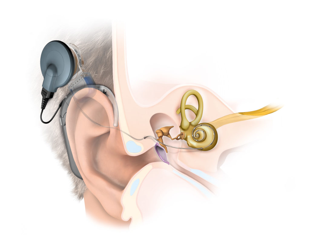 An image of a cutaway of a human ear with a cochlear implant attached. The image shows the internal and external portions of the implant.